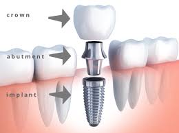 implant