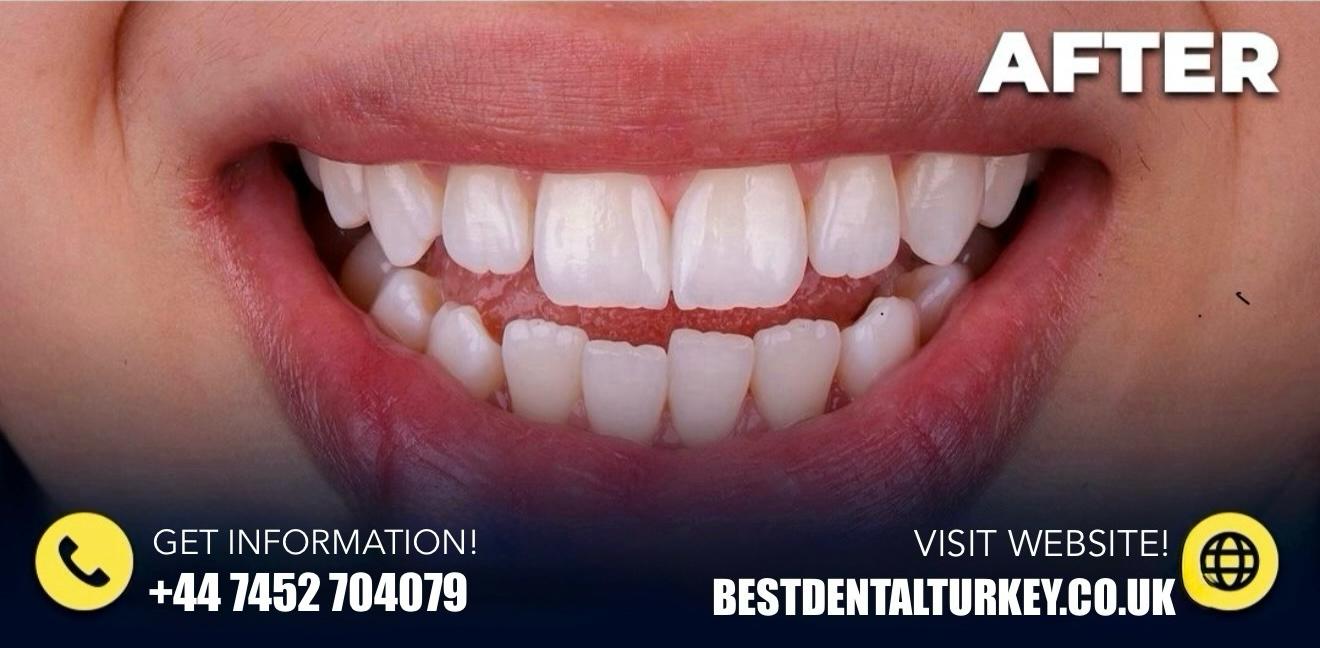 BEST DENTAL TÜRKİYE AFTER